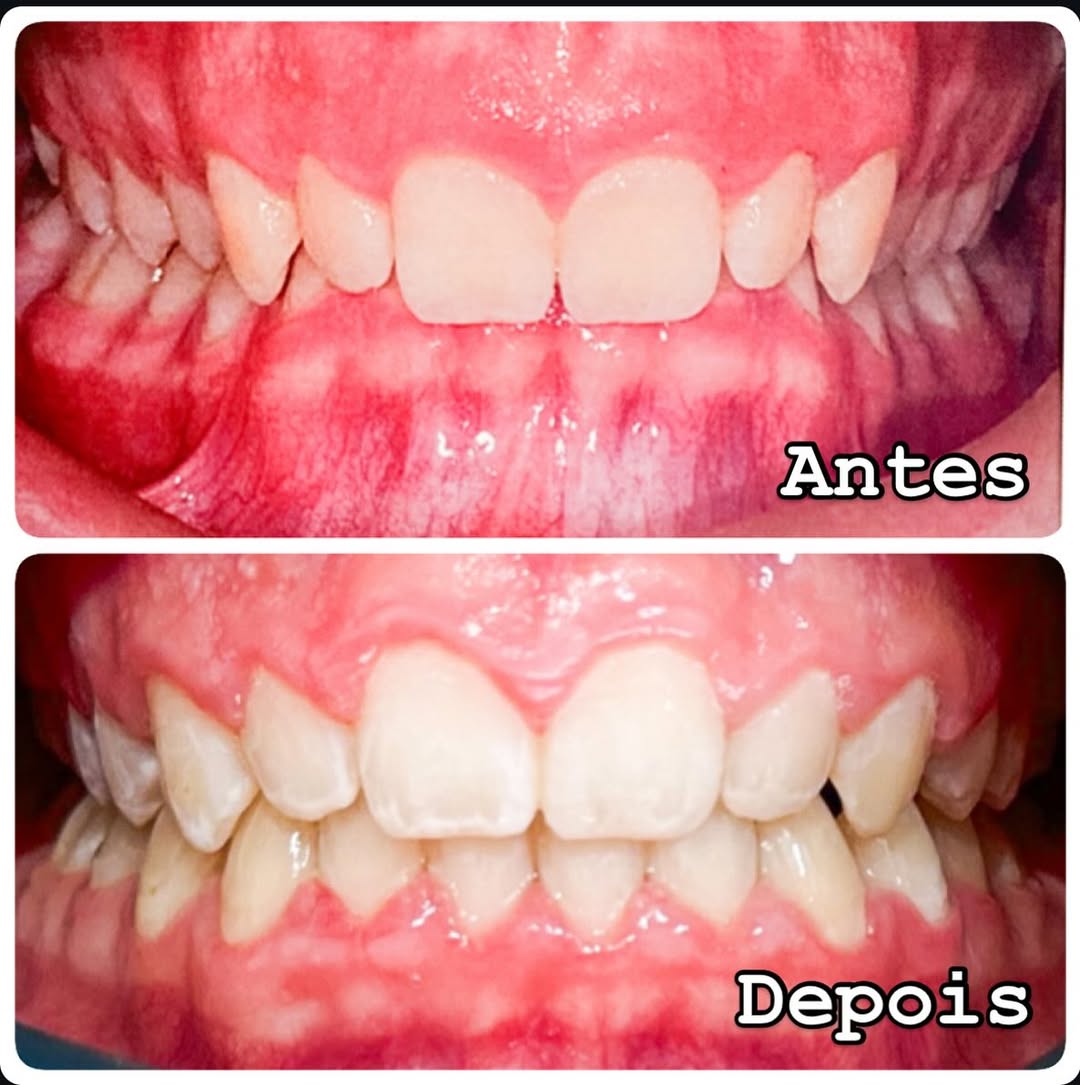 Tratamento com Alinhadores (antes e depois)